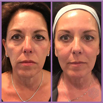 Glow & Lift Facial Massager